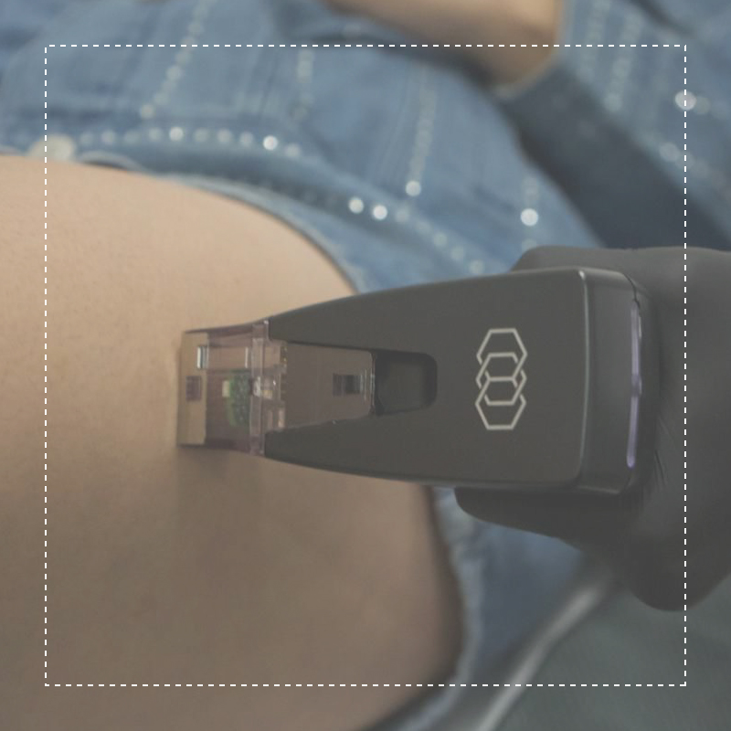 Tratamiento de cicatrices