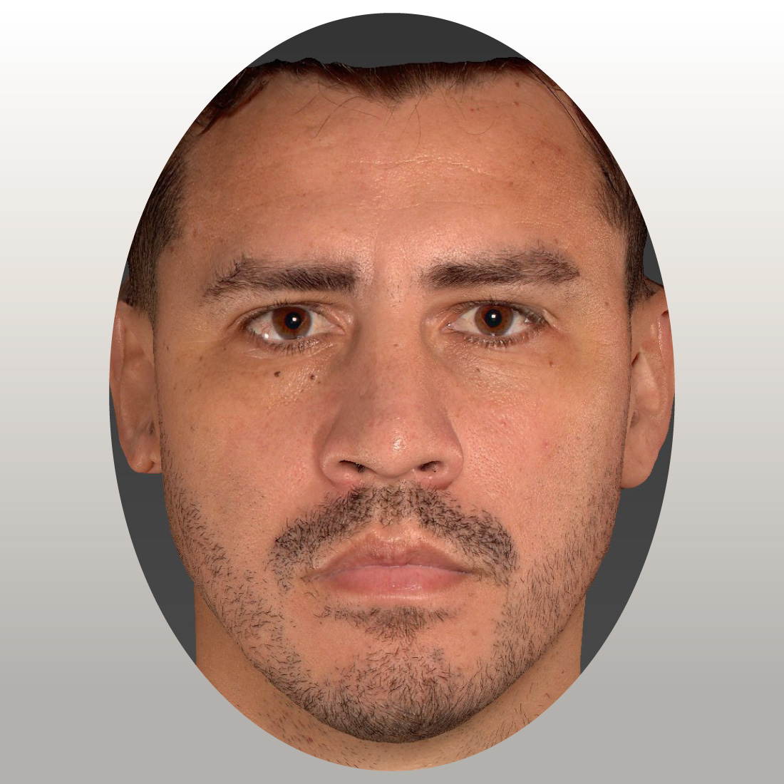 armonizacion-facial-antes-1