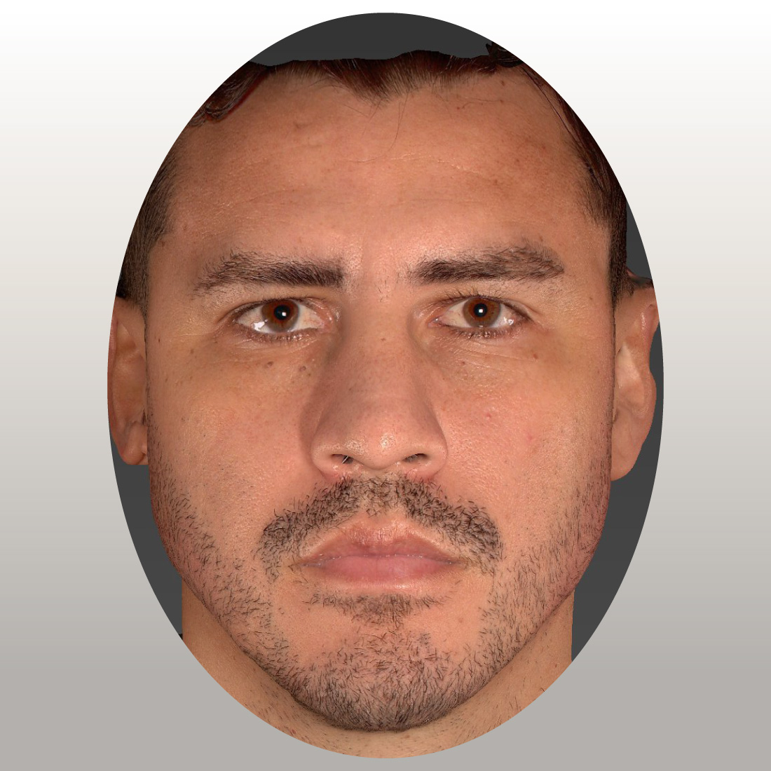 armonizacion-facial-despues-1