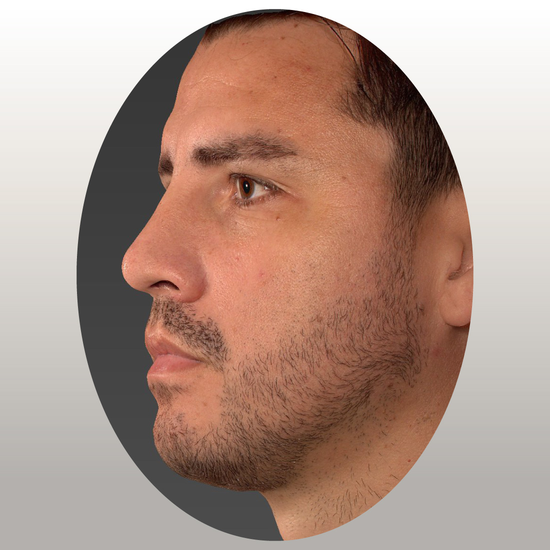 marcaje-mandibular-antes