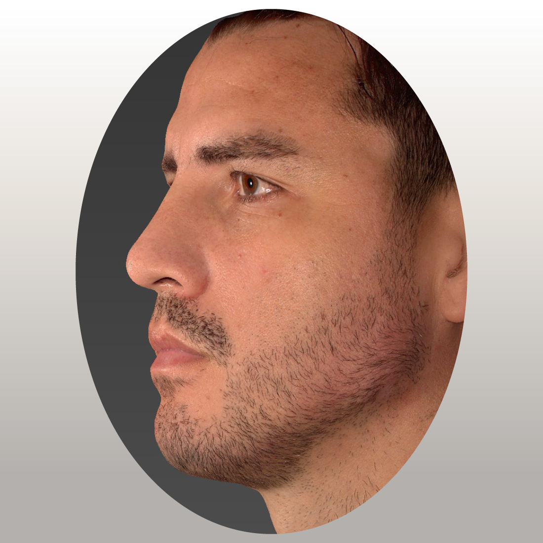 marcaje-mandibular-despues