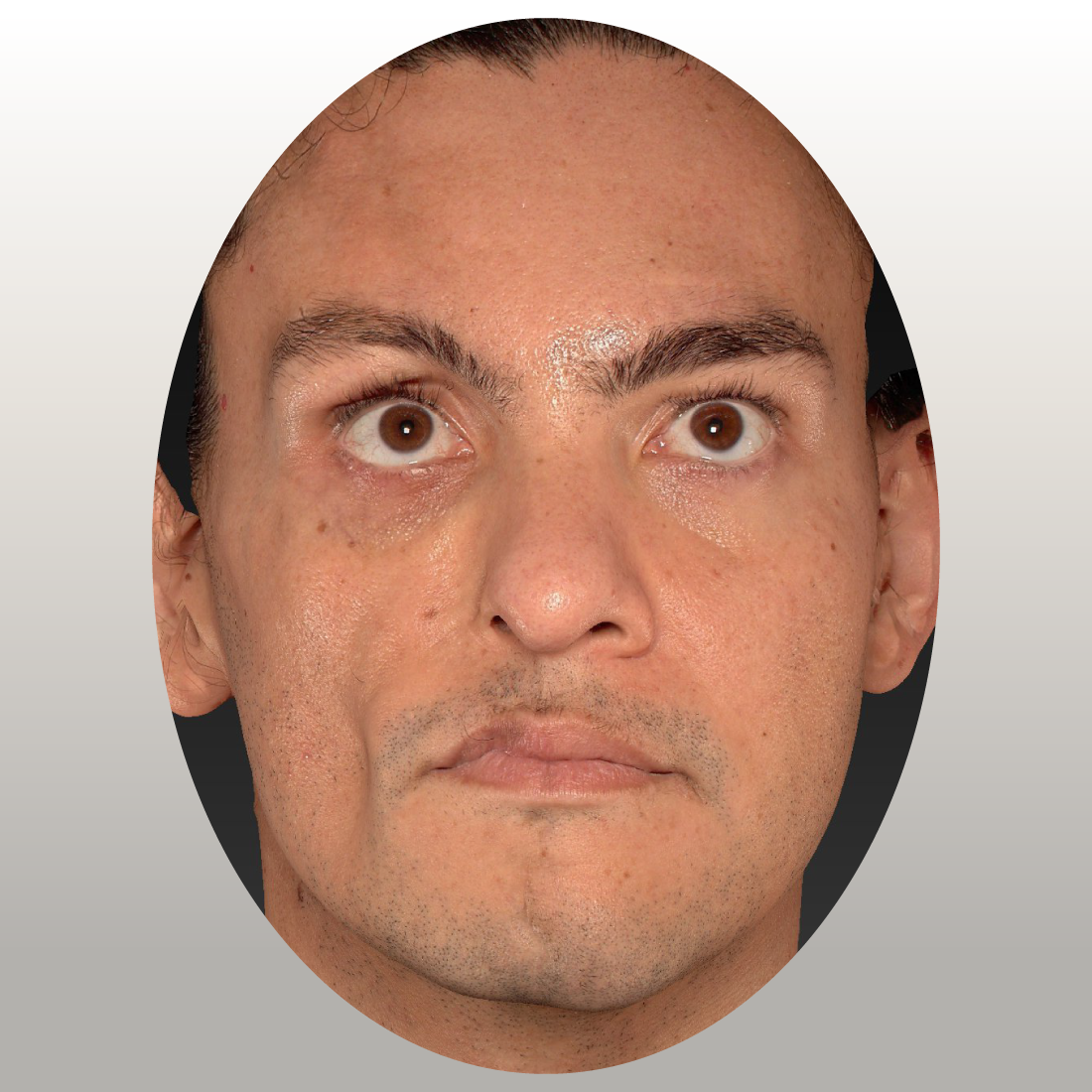 Armonización Facial