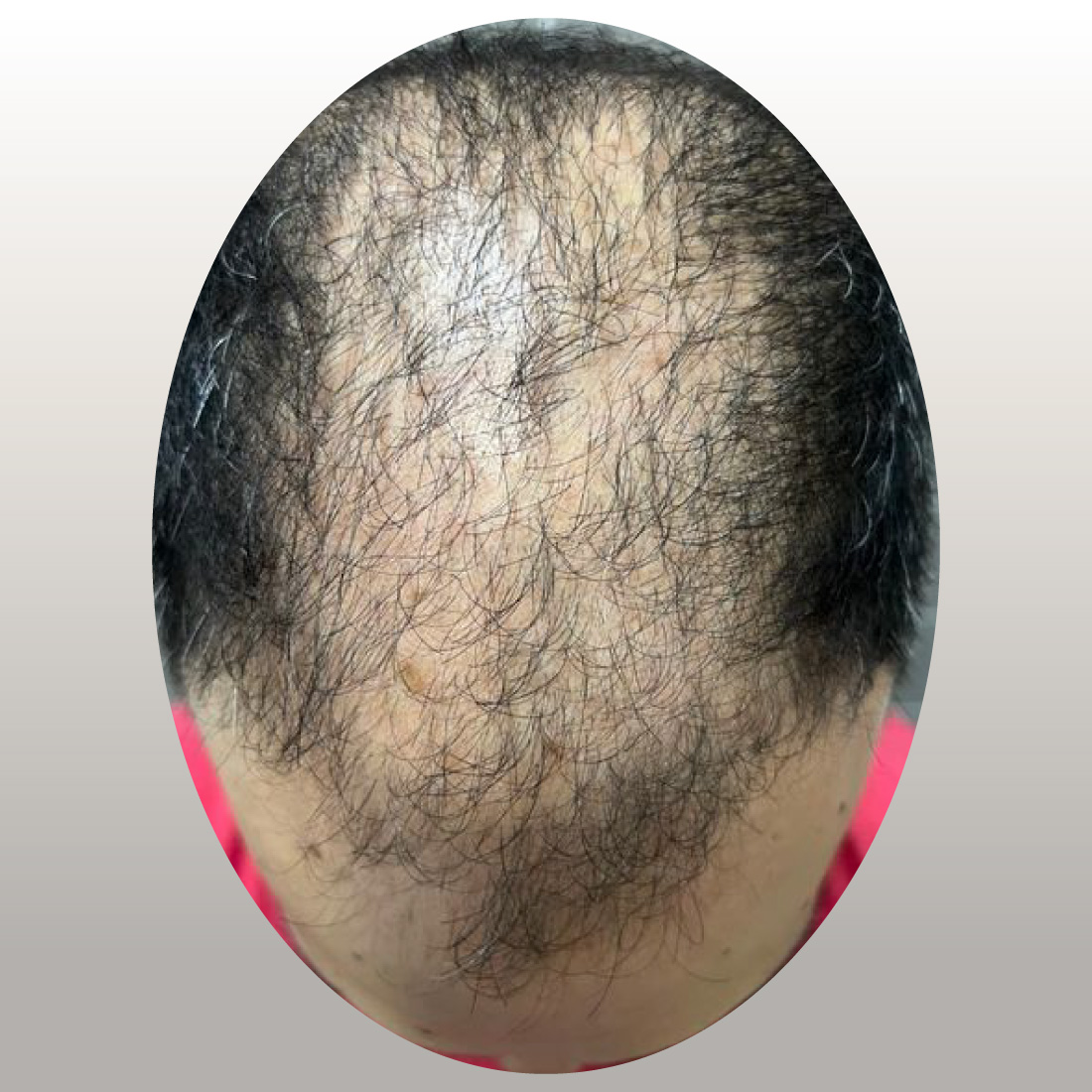 regenera-antes